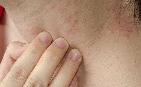 艾滋病一开始的皮肤图 女性，会出现大面积红色皮疹