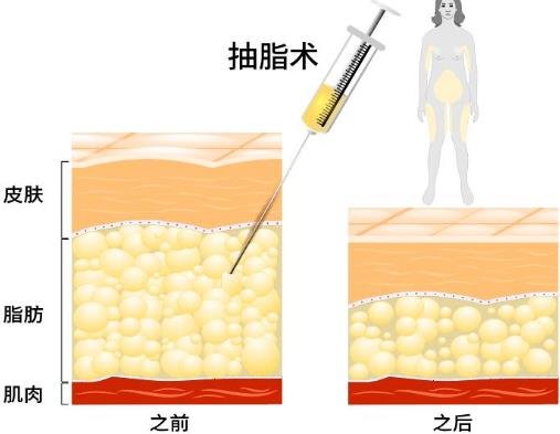 抽脂肪20斤一般多少钱，2万元左右