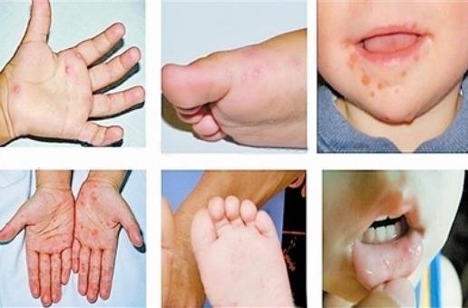 手足口病症状初期图片，手/足/口处的小疱疹最典型