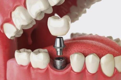 种植牙的五大危害，可能会导致骨吸收/牙周炎等