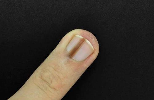 指甲有黑色竖条纹什么情况，可能是甲母痣或心肌供血不足造成