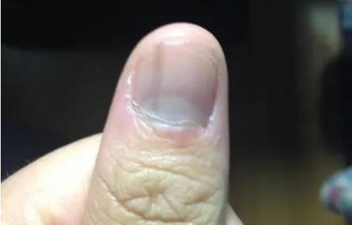 指甲有黑色竖条纹什么情况，可能是甲母痣或心肌供血不足造成