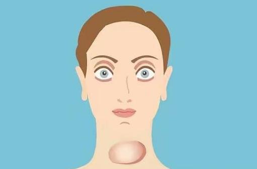 女人得了甲亢最初表现，甲状腺肿大/眼球突出最明显