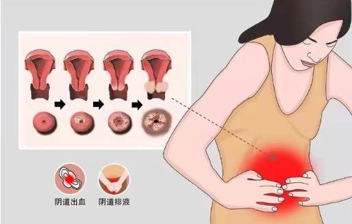 宫颈癌有6个前兆，阴道出血/下腹疼痛/阴道异味是最容易发现的征兆