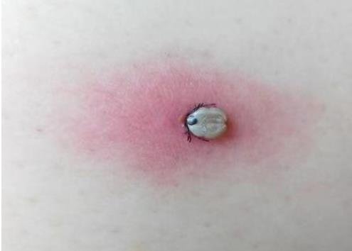 蜱虫咬人后的伤口图